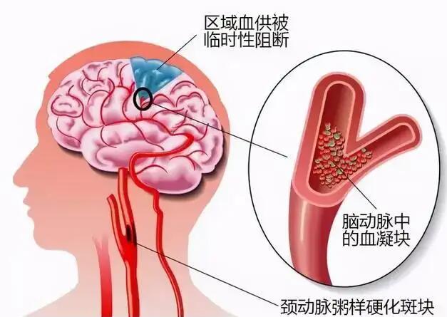 經(jīng)顱多普勒儀器廠家?guī)私饽X動脈硬化的臨床表現(xiàn)