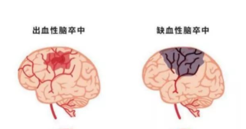 「腦部聽診器」彩色經(jīng)顱多普勒檢測顱內(nèi)動脈